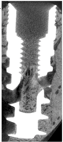 Micro-CT image showing bone ingrowth into internal chamber of KiiS